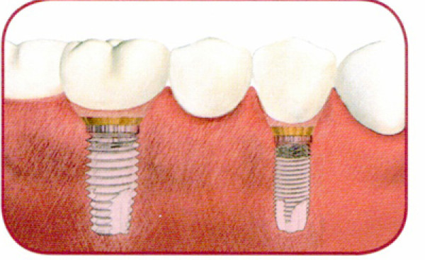 Implant dentaire - Province de Liège