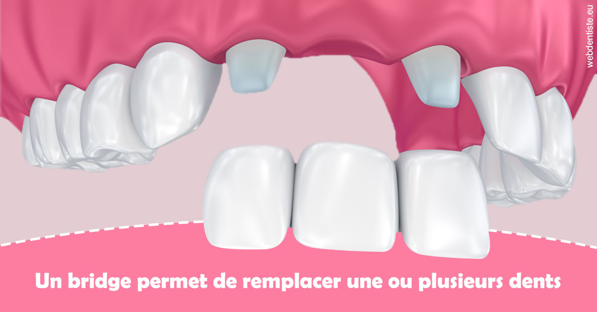 https://www.cabinet-dentaire-lorquet-deliege.be/Bridge remplacer dents 2