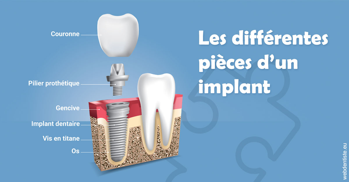 https://www.cabinet-dentaire-lorquet-deliege.be/Les différentes pièces d’un implant 1